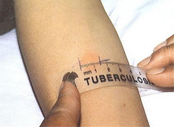 Бил Гейтс: Светът прави огромна грешка, като не инвестира повече в туберкулозата